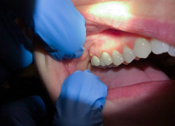 Best Emergency Tooth Extraction in Rochelle, GA